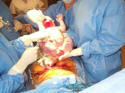 Caesarian