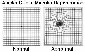 Macular degeneration - Psychology Wiki